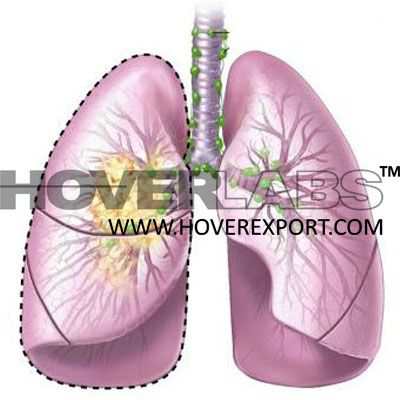 肺癌遗体模型