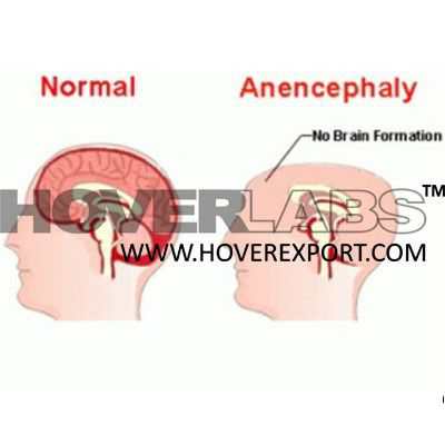 Anencephaly Model